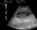 Ultraschallbild eines etwa 28 Tage alten Fötus